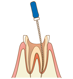 歯根治療