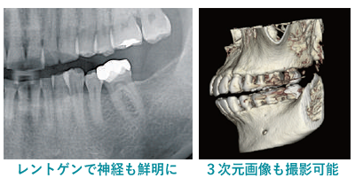歯根治療：CTを用いての画像診断